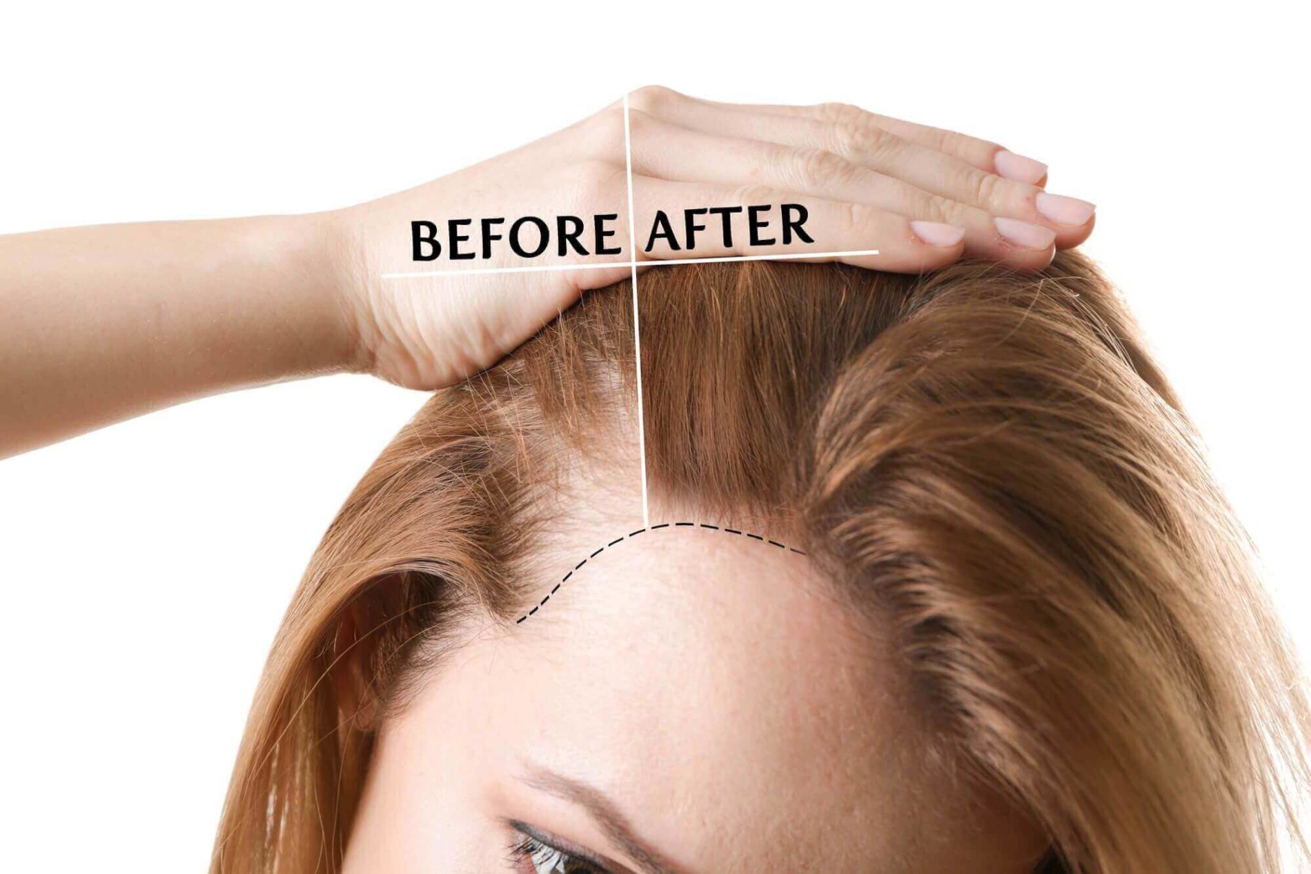 hair loss treatment