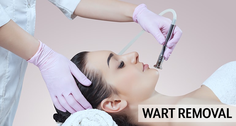 Warts Treatment dubai